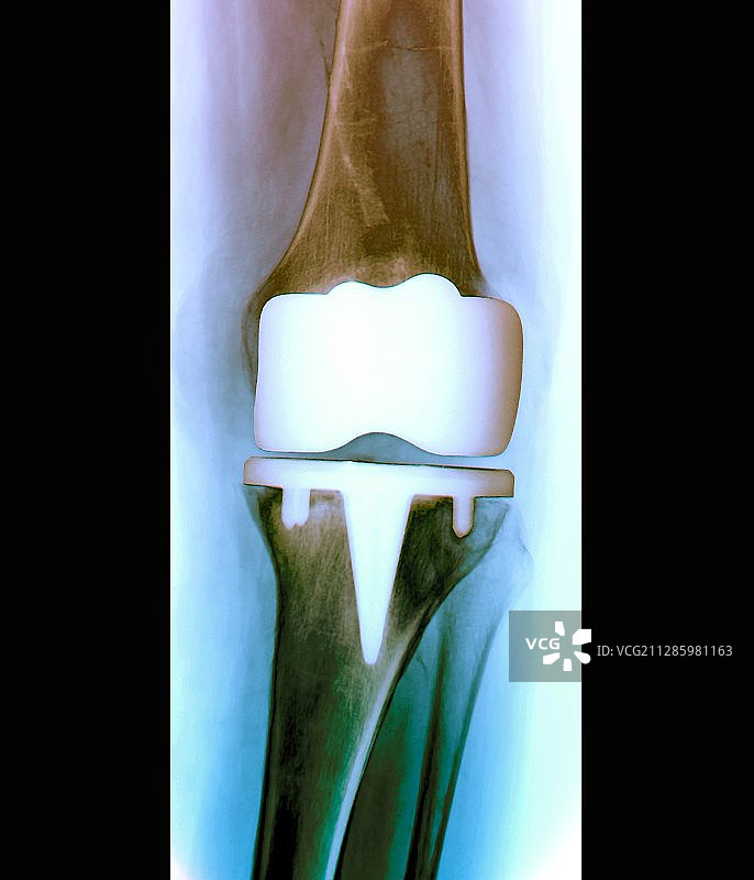 假体膝关节X光片图片素材