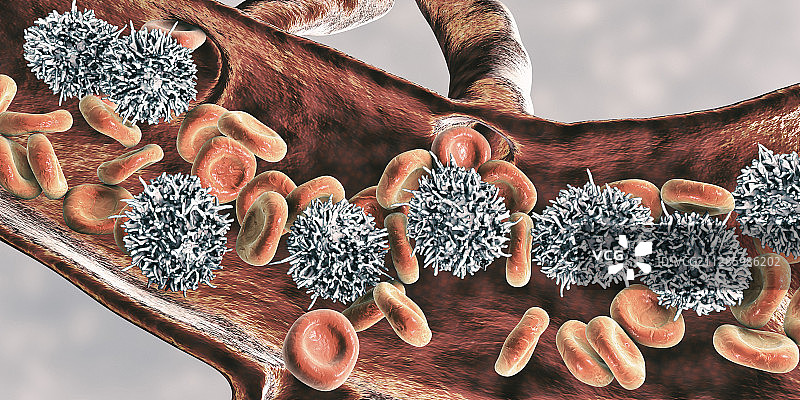 毛细胞白血病插图图片素材