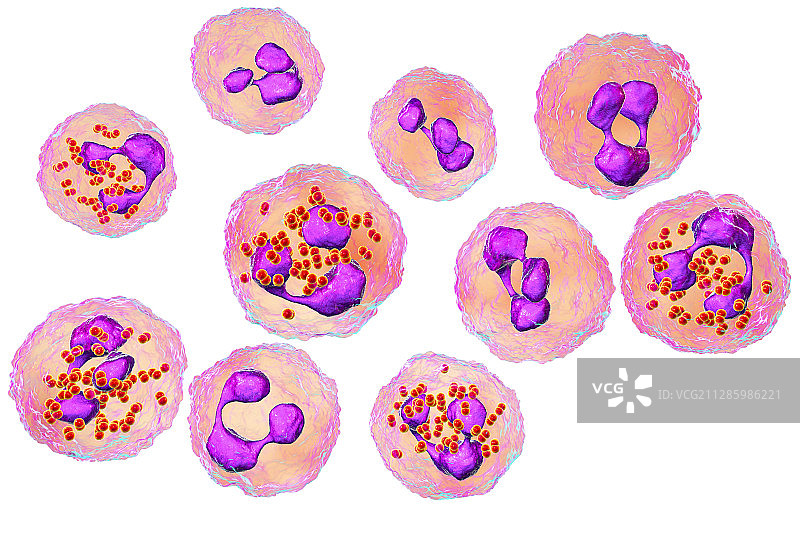 流行性脑脊髓膜炎，图示图片素材