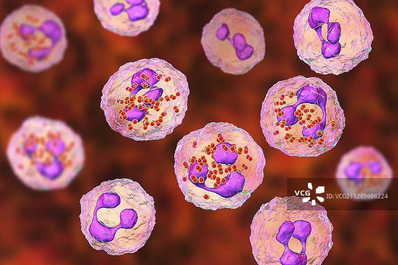 流行性脑脊髓膜炎，图示图片素材