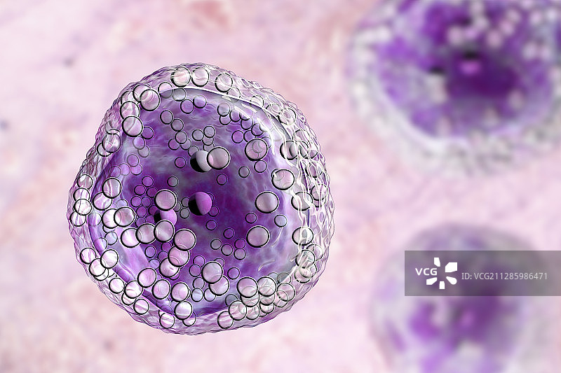 伯基特淋巴瘤细胞图图片素材