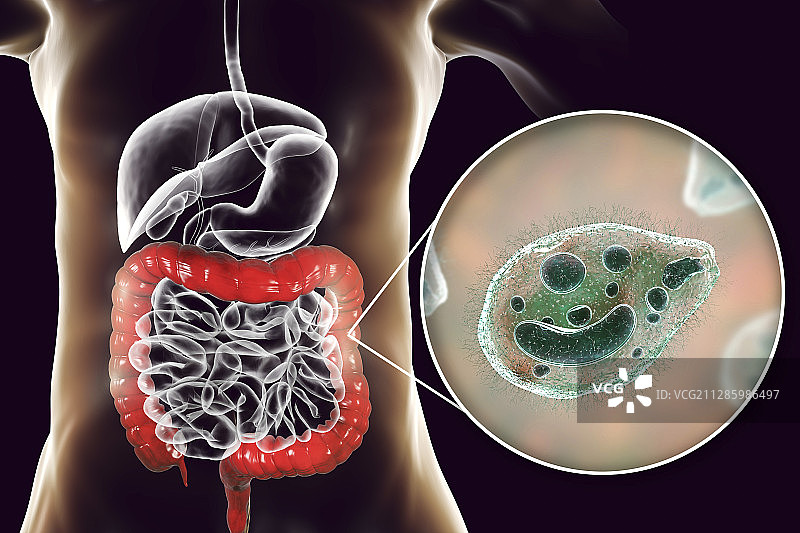 巴兰蒂斯病概念图图片素材