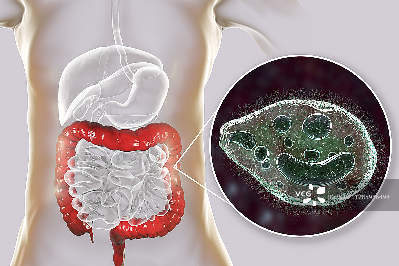 巴兰蒂斯病概念图图片素材