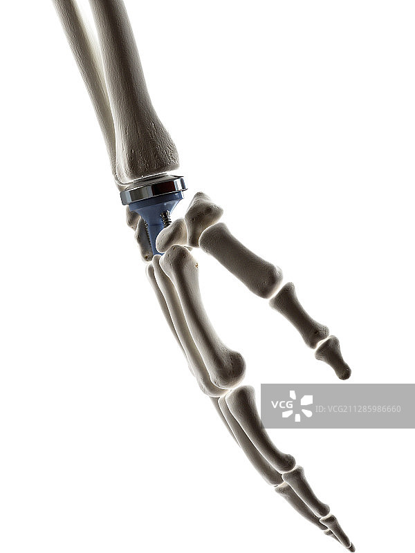 腕关节置换插画图片素材