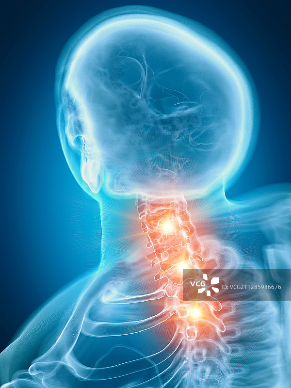 疼痛的颈椎插画图片素材