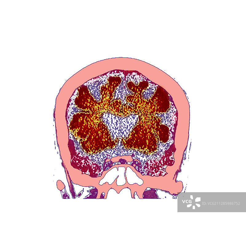 痴呆症大脑CT扫描图片素材