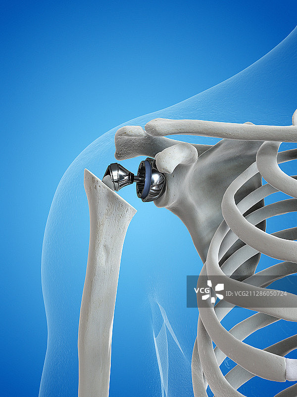 肩关节置换插画图片素材