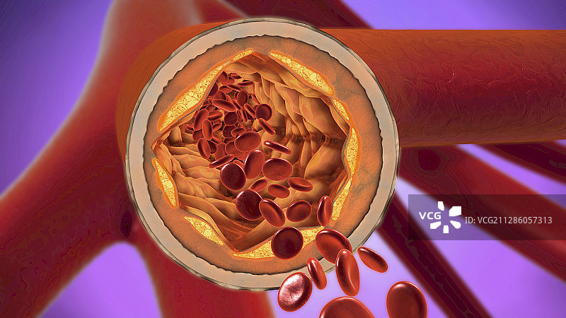动脉粥样硬化示意图图片素材