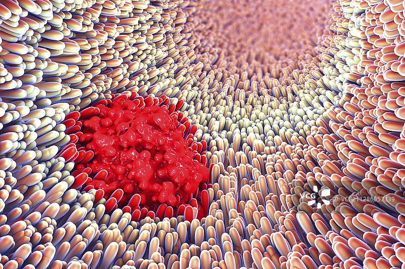 胃溃疡插图图片素材