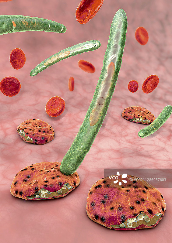 疟疾插图图片素材