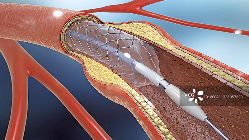 动脉支架，图示图片素材