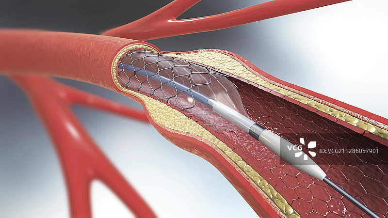 动脉支架、插图图片素材