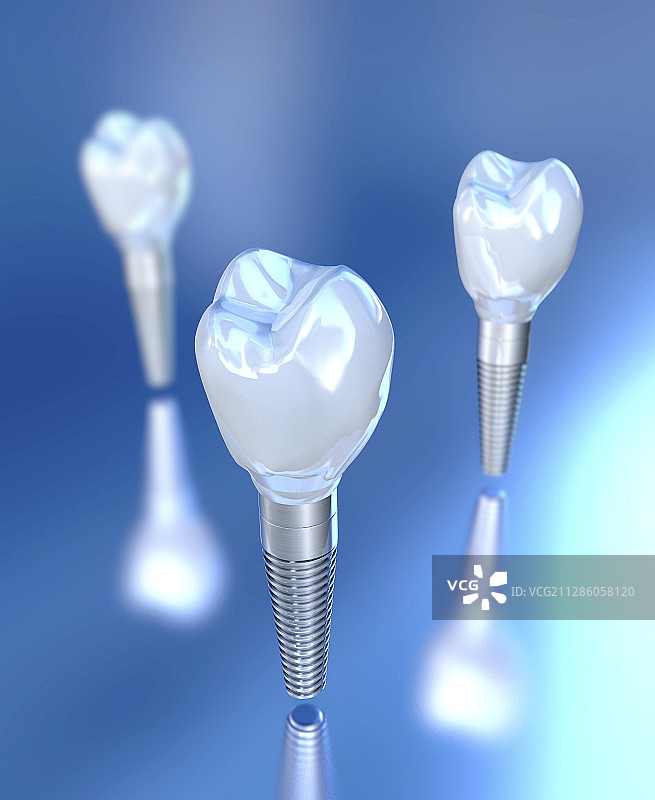 牙科种植体插图图片素材