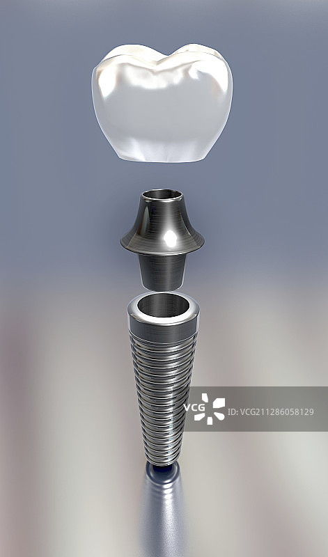 牙科植入体插图图片素材