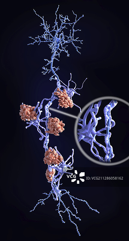 多发性硬化症中的神经损伤图片素材