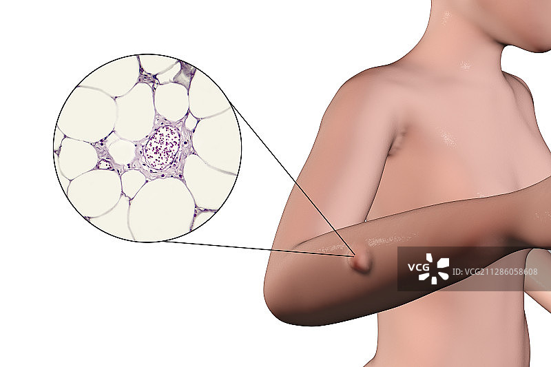 脂肪瘤合成图图片素材