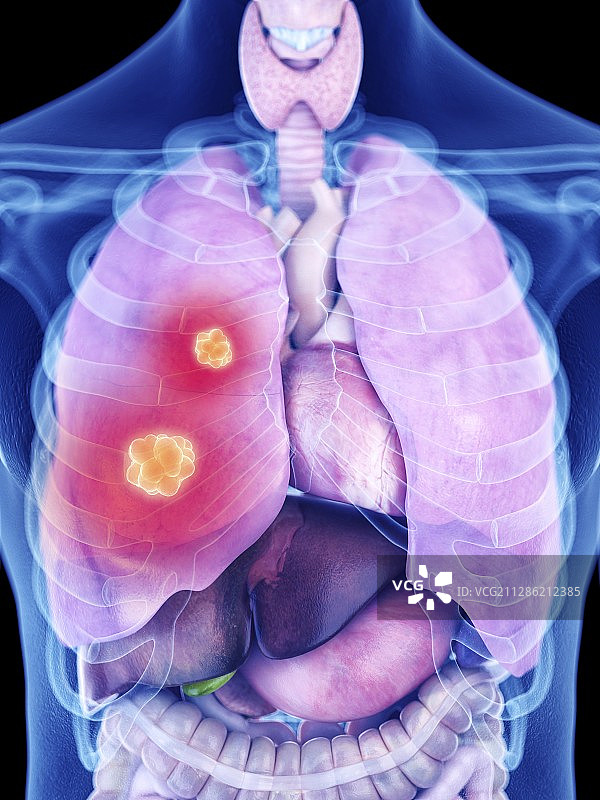 肺癌插画图片素材