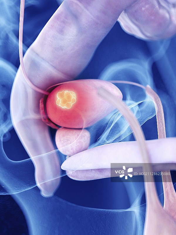 膀胱癌插画图片素材