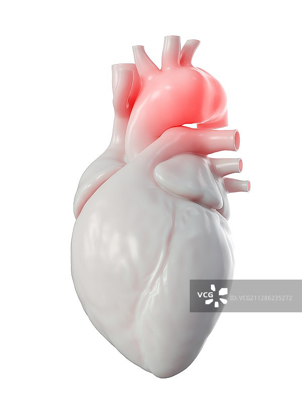 主动脉瘤图示图片素材