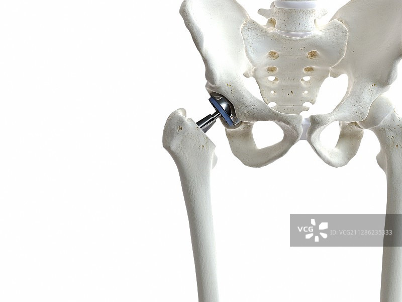 髋关节置换插画图片素材