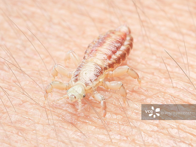人皮肤上的头虱插画图片素材