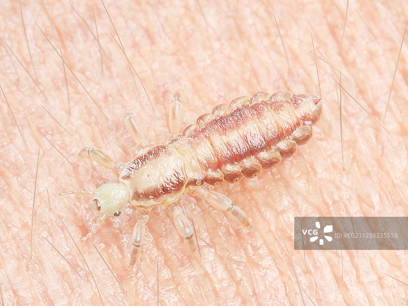 人皮肤上的头虱插画图片素材