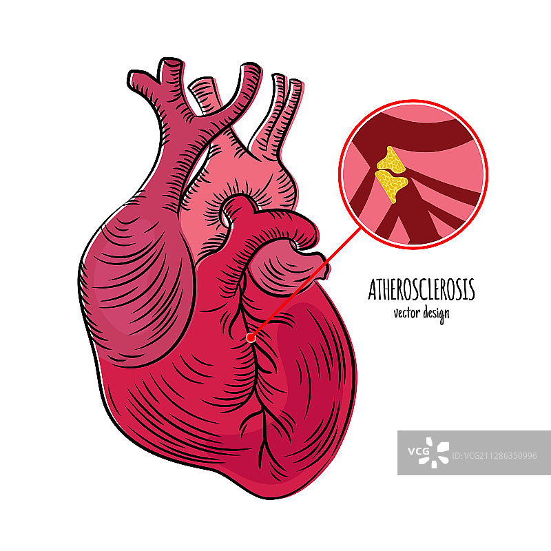动脉粥样硬化慢性疾病医学图片素材
