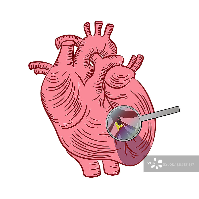 心肌梗塞心脏疾病医学图片素材