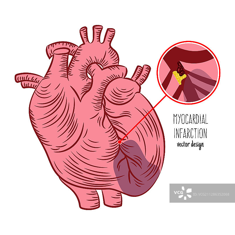 心肌梗死示意图心脏病医学图片素材