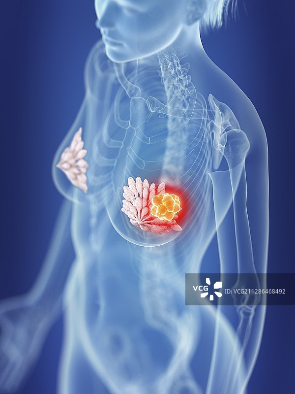 女性乳腺癌插画图片素材
