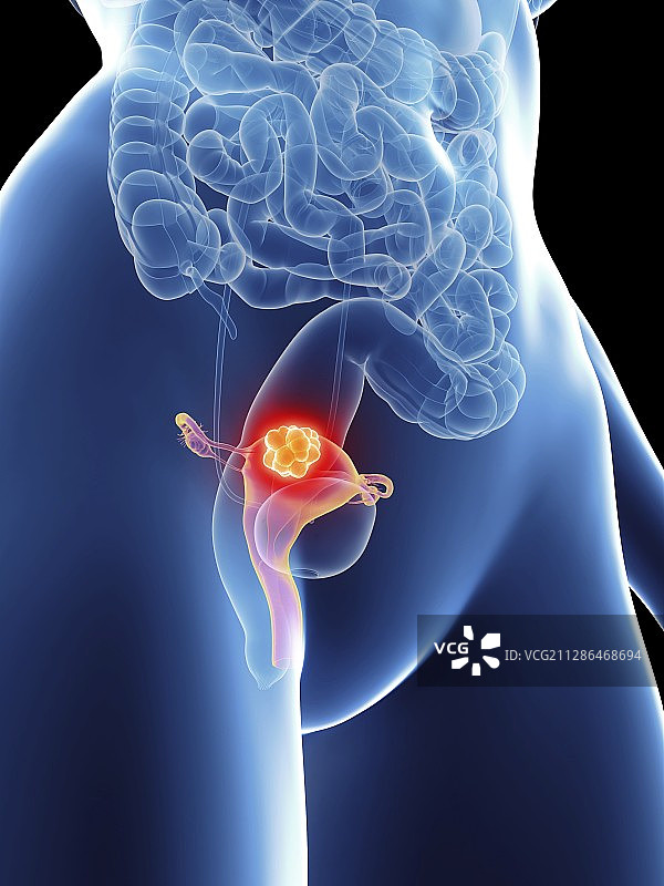 女性子宫癌插画图片素材