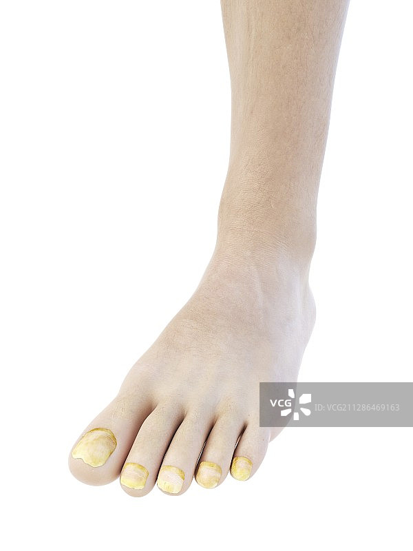 脚趾甲真菌插画图片素材