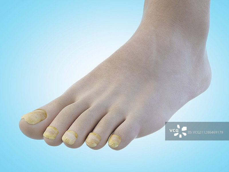 脚趾甲真菌插画图片素材