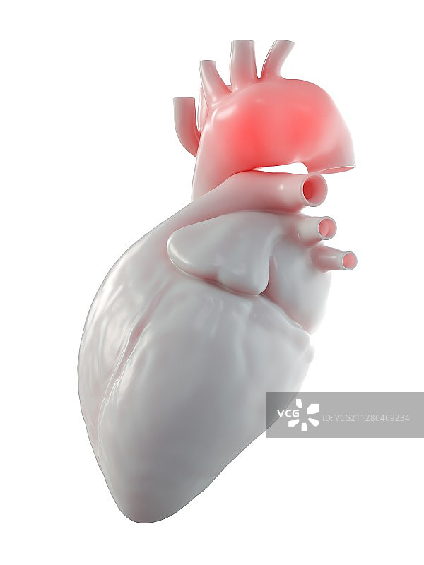 主动脉瘤图示图片素材