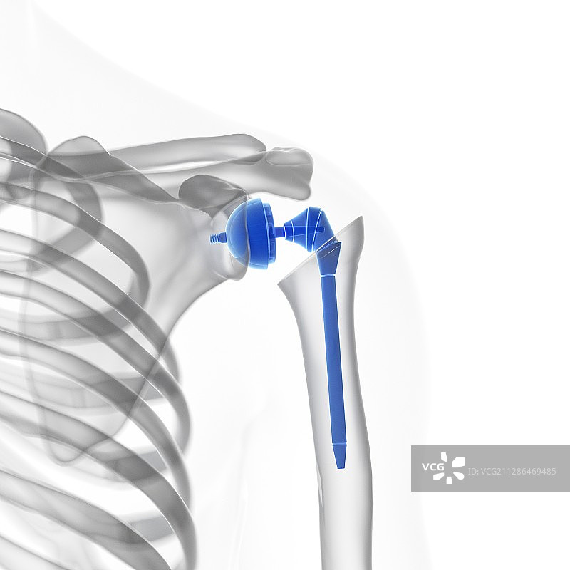 肩关节置换插画图片素材