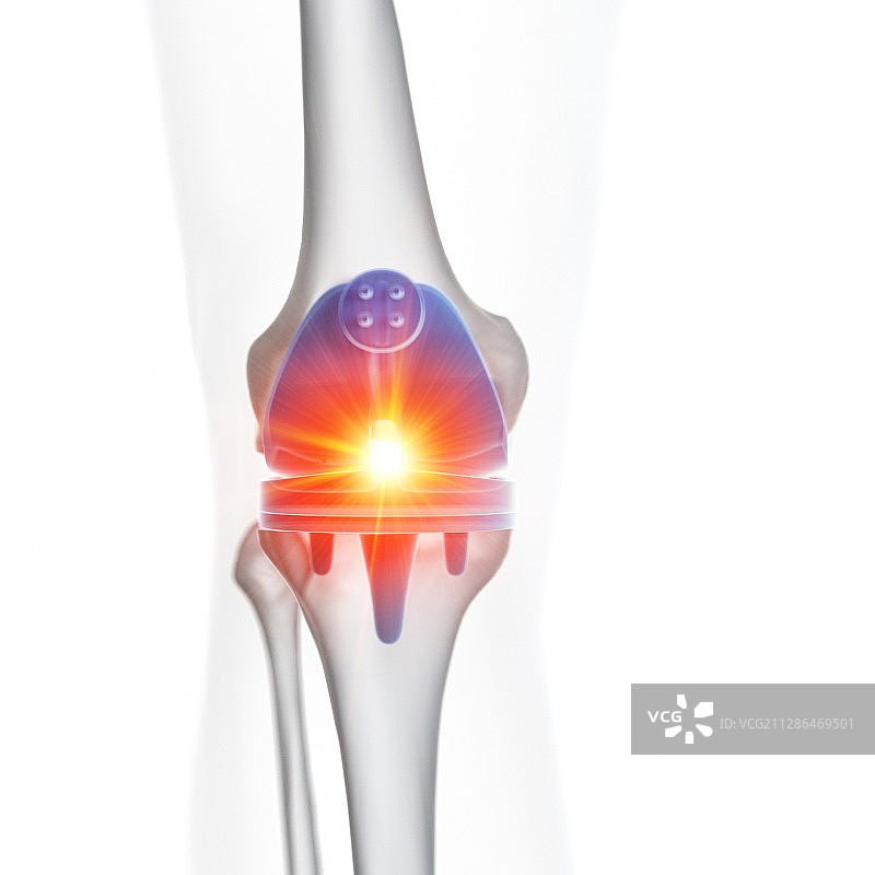 膝关节置换手术图示图片素材