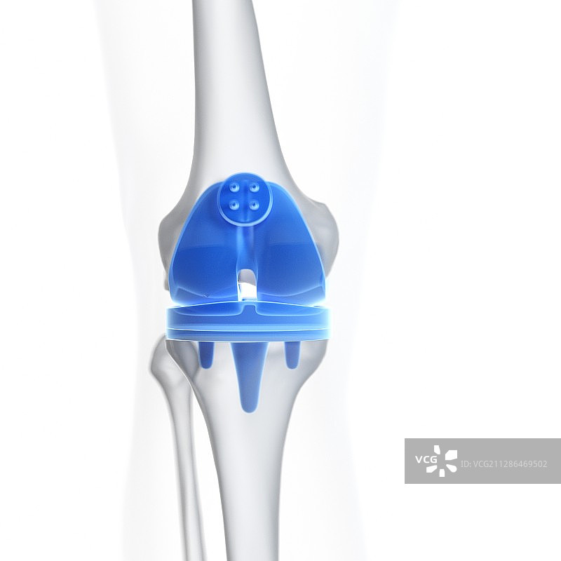 膝关节置换手术图示图片素材