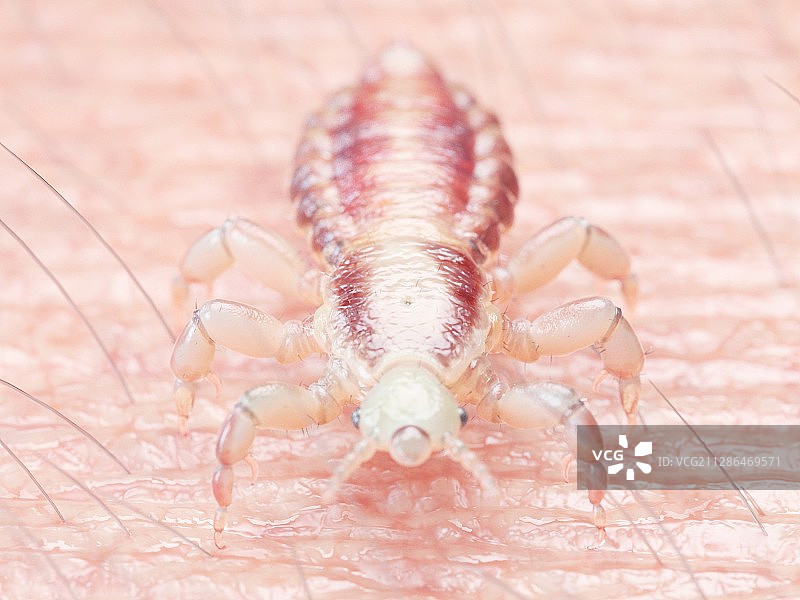 人皮肤上的头虱插画图片素材