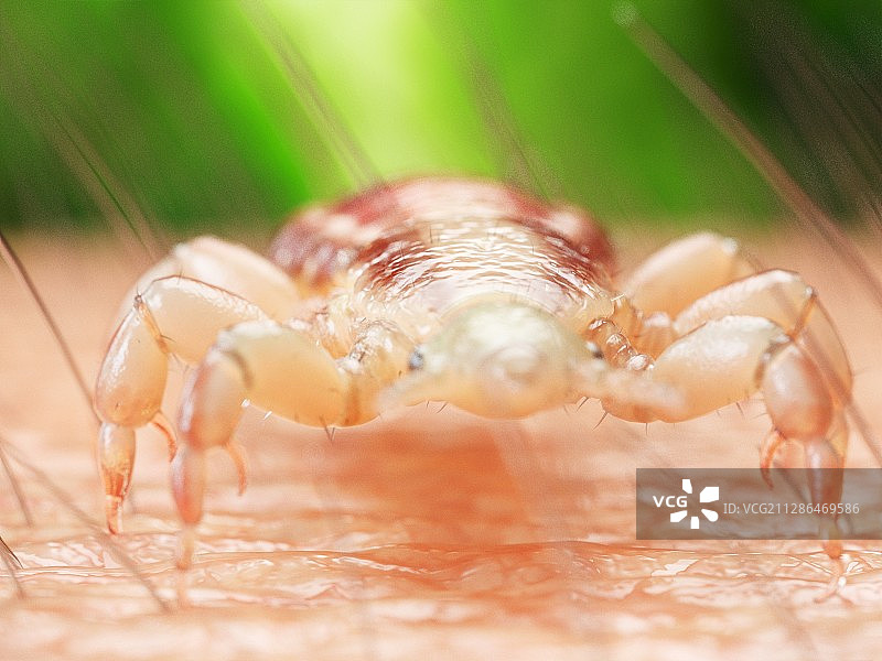 人皮肤上的头虱插画图片素材