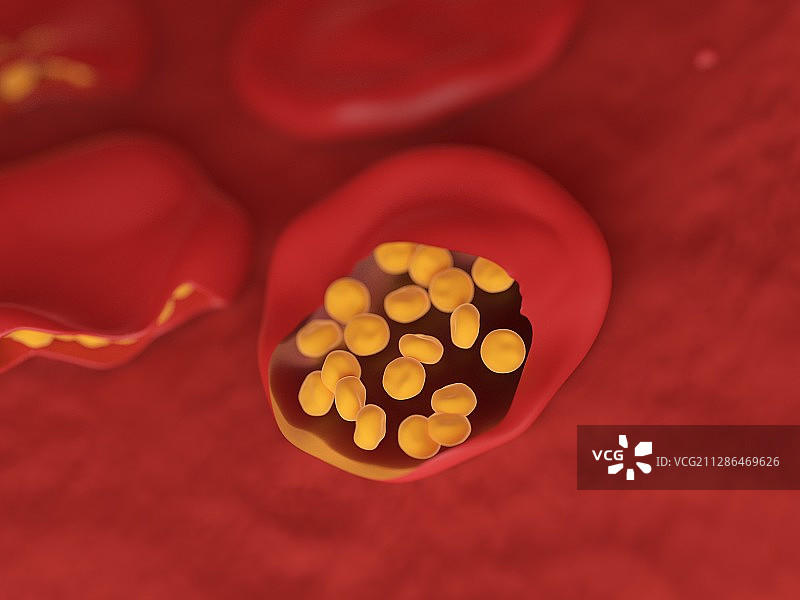 疟疾感染血细胞插画图片素材