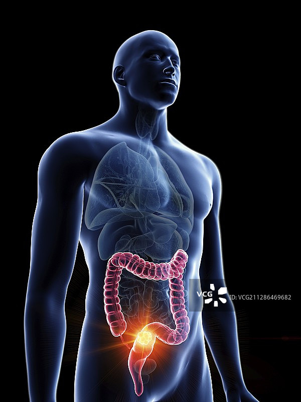 男人的结肠肿瘤插画图片素材