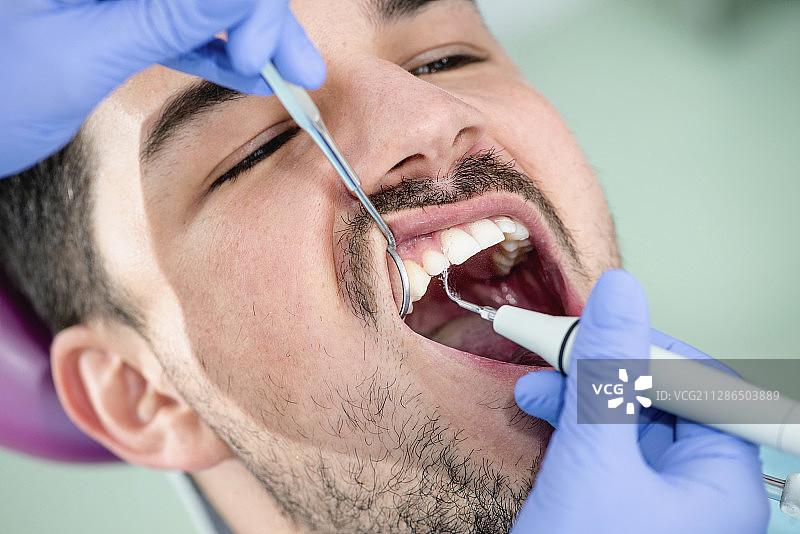 去除牙结石图片素材