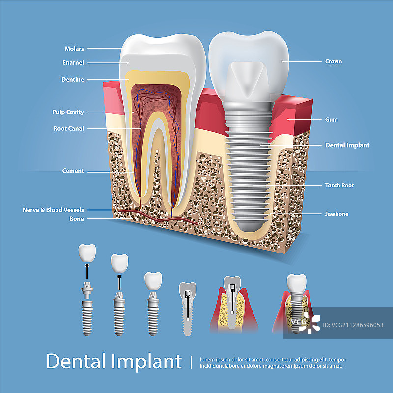 人的牙齿和牙科植入物图片素材