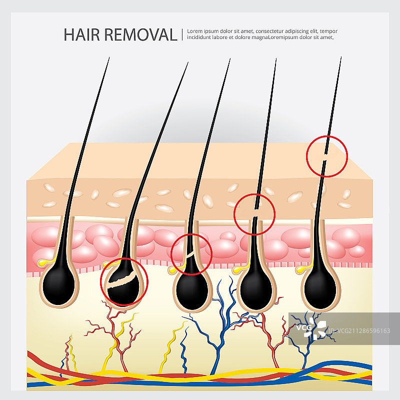 脱毛示例图片素材