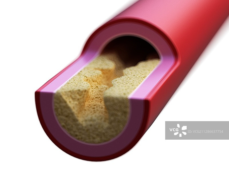 动脉阻塞插画图片素材