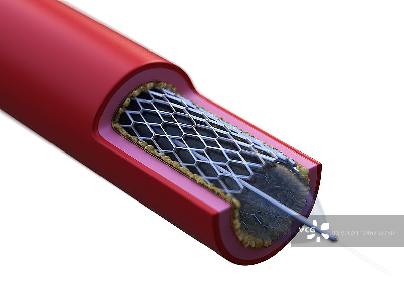 支架工作原理插画图片素材