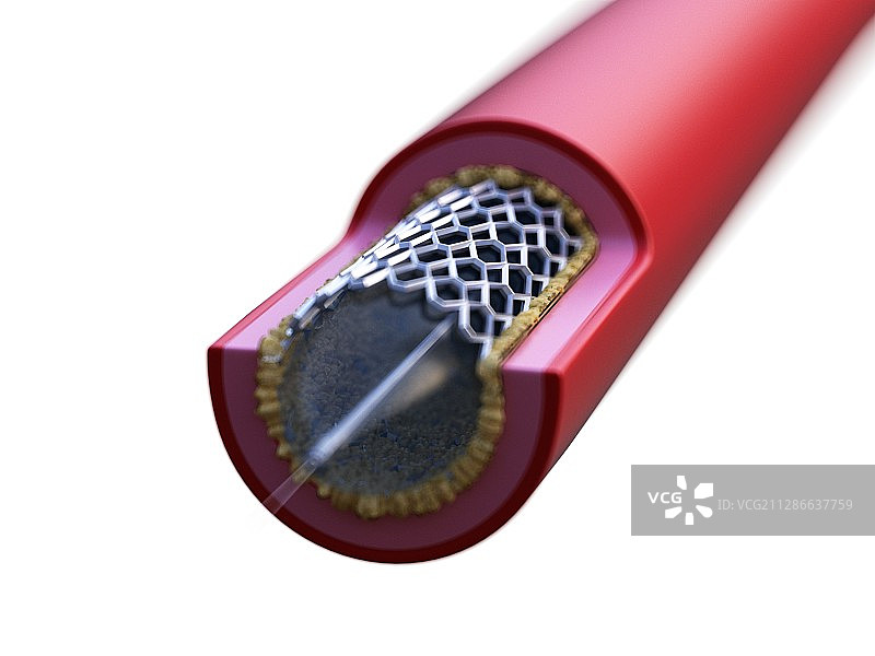 动脉支架植入插画图片素材