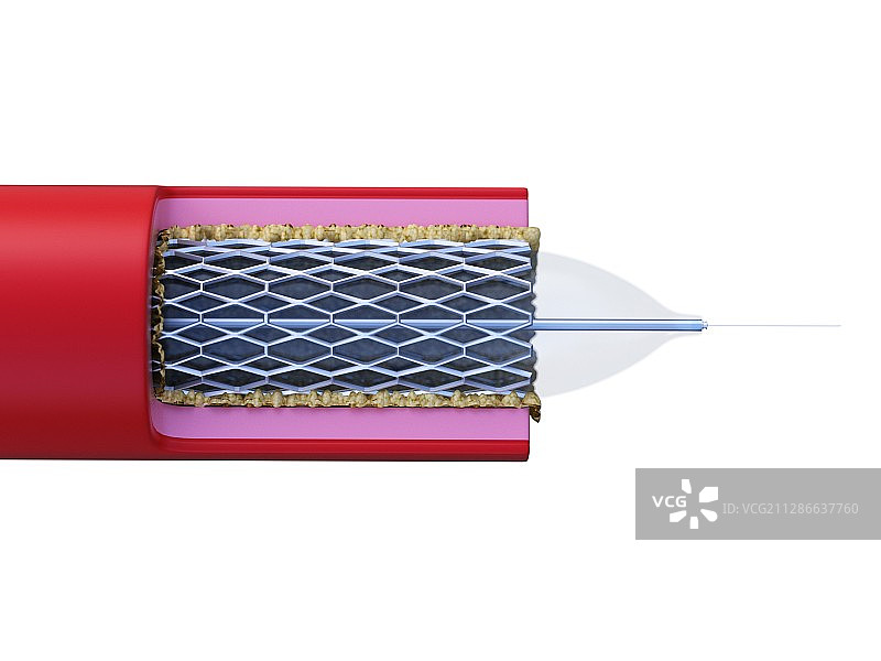 动脉支架植入插画图片素材