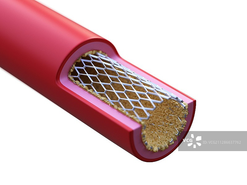 动脉支架植入插画图片素材