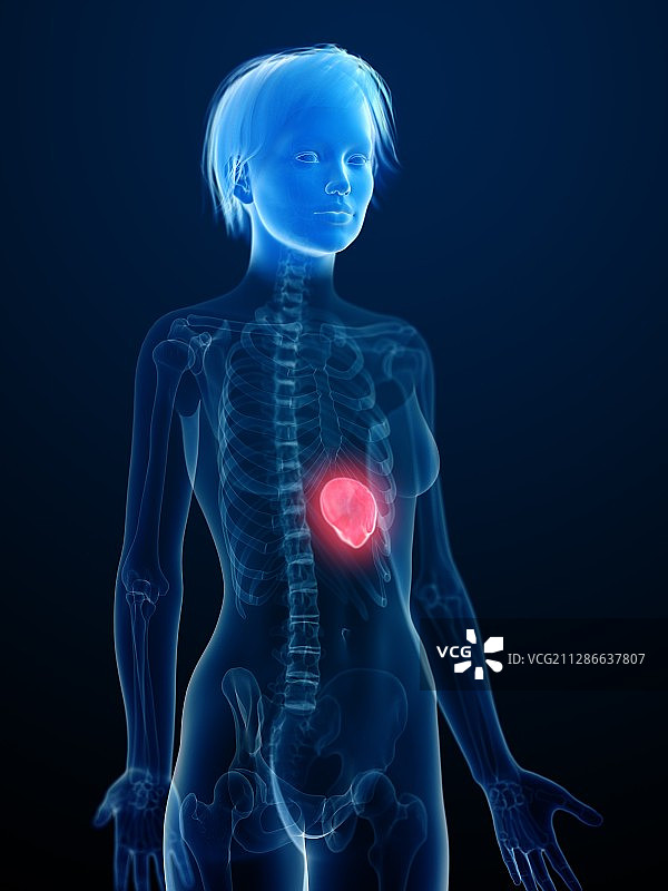 发炎的脾脏插画图片素材